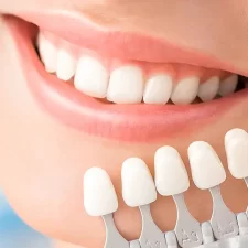 From Chips to Gaps: What Dental Issues Can Veneers Fix?