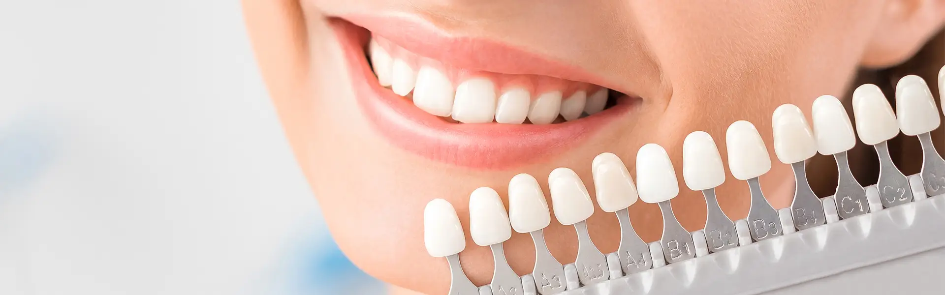 From Chips to Gaps: What Dental Issues Can Veneers Fix?