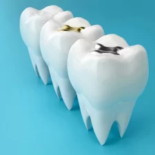 Are Composite Fillings the Right Choice for Your Dental Needs?