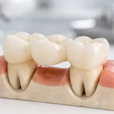 Prevent Tooth Shifting with Dental Bridges in Cambridge